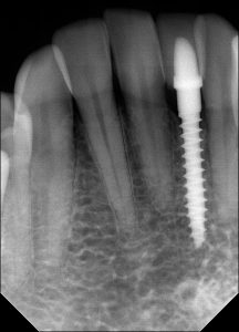 Mini Dental Implant x-ray