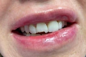 Veneer tooth fracture