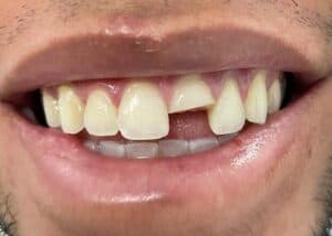 Cracked tooth