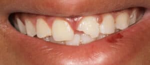 Fractured front tooth