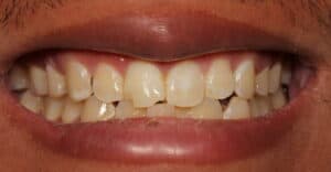 chipped front tooth